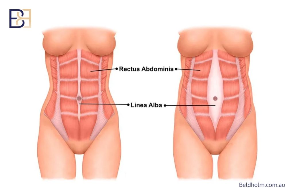 Repair of Diastasis Recti