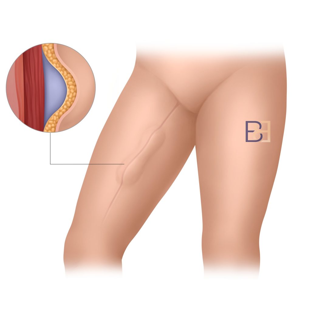 Seroma and Lymphatic Fluid Collections