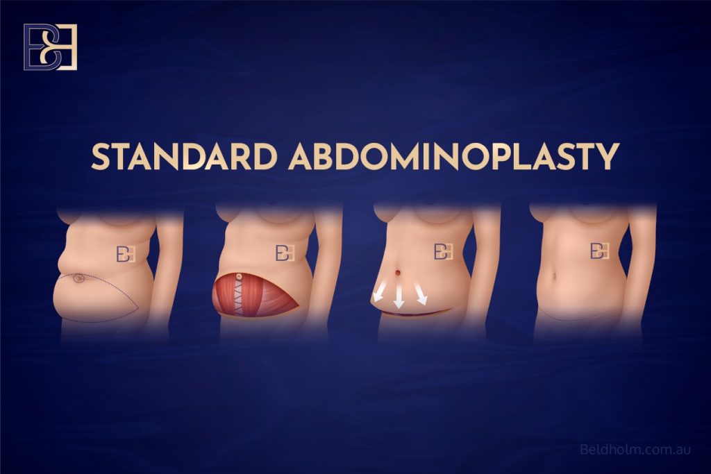 Excess Skin After Weight Loss – Surgical Options for the Abdomen and Lower Torso 8 Standard Abdominoplasty (Tummy Tuck)
