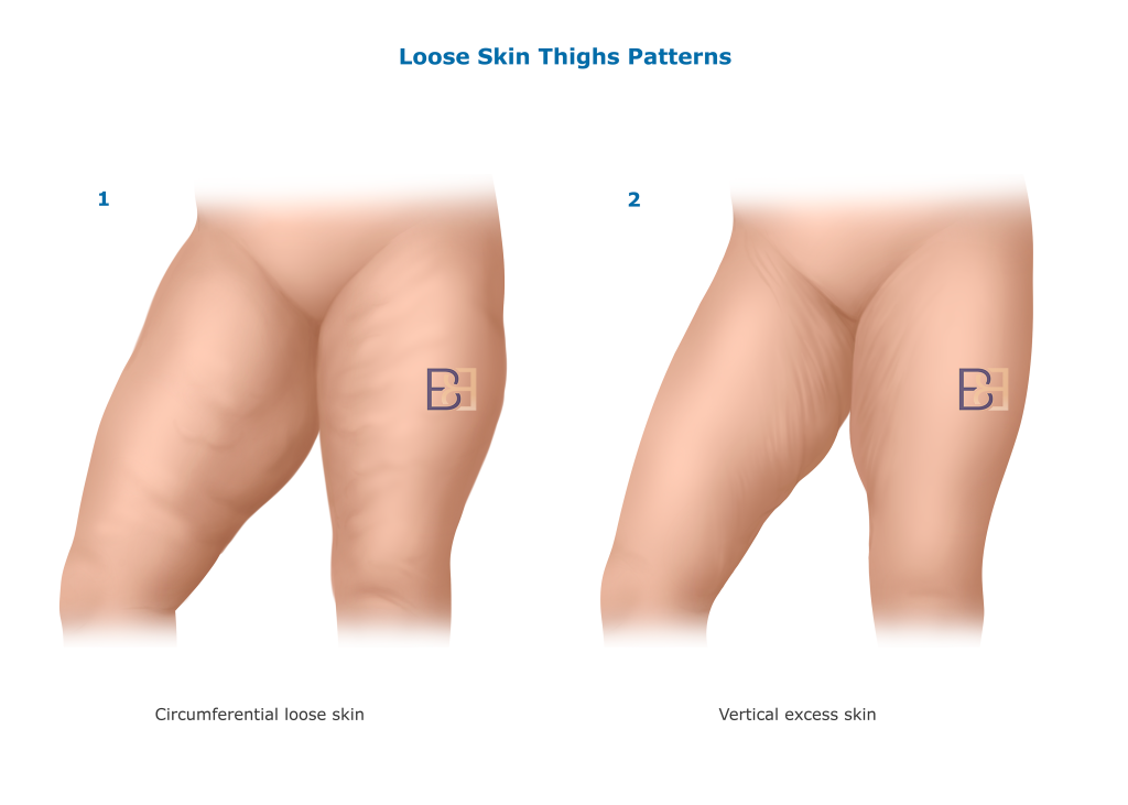 Thigh vertical and horizontal loose skin