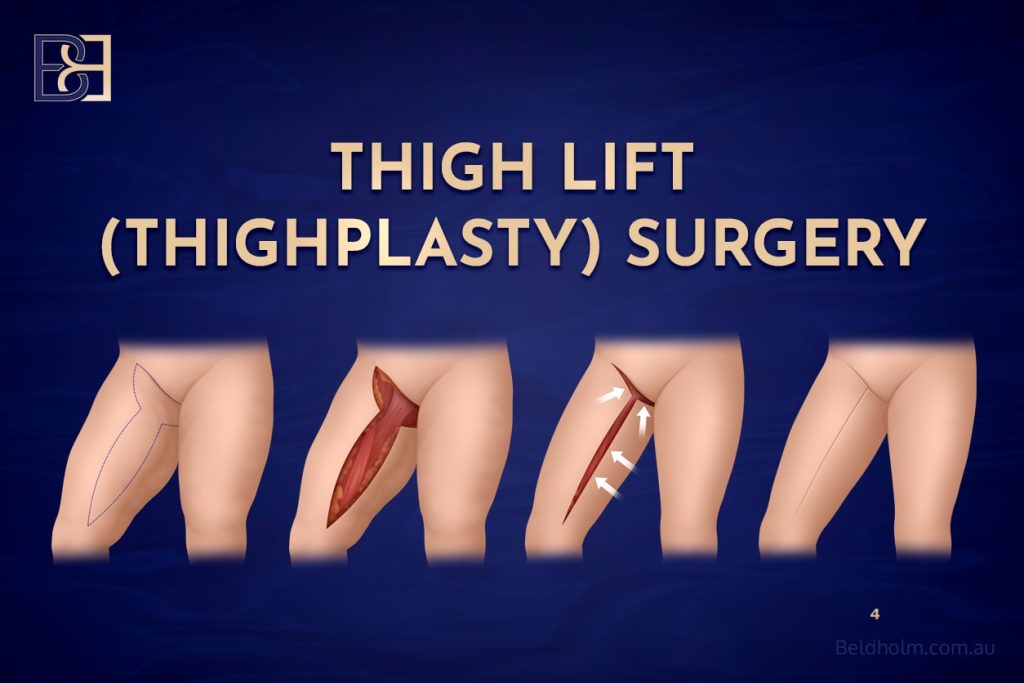 Thighplasty (Inner Thigh Lift) After Weight Loss
