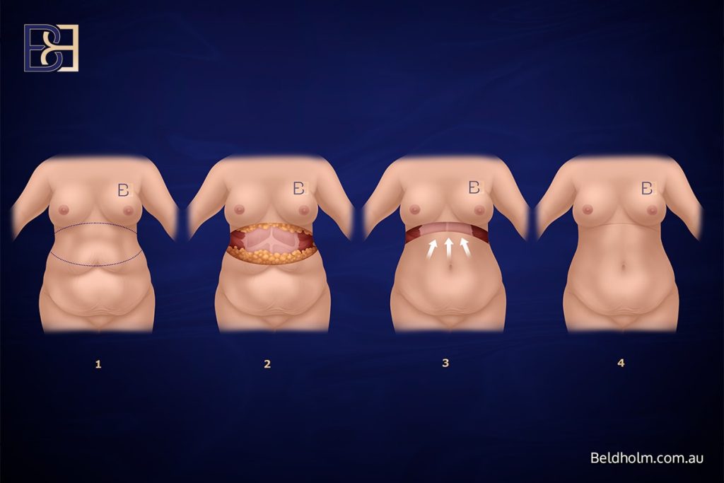 Upper abdominal lipectomy