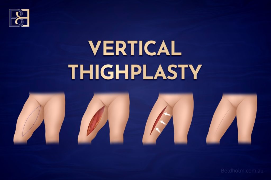 Vertical Thighplasty