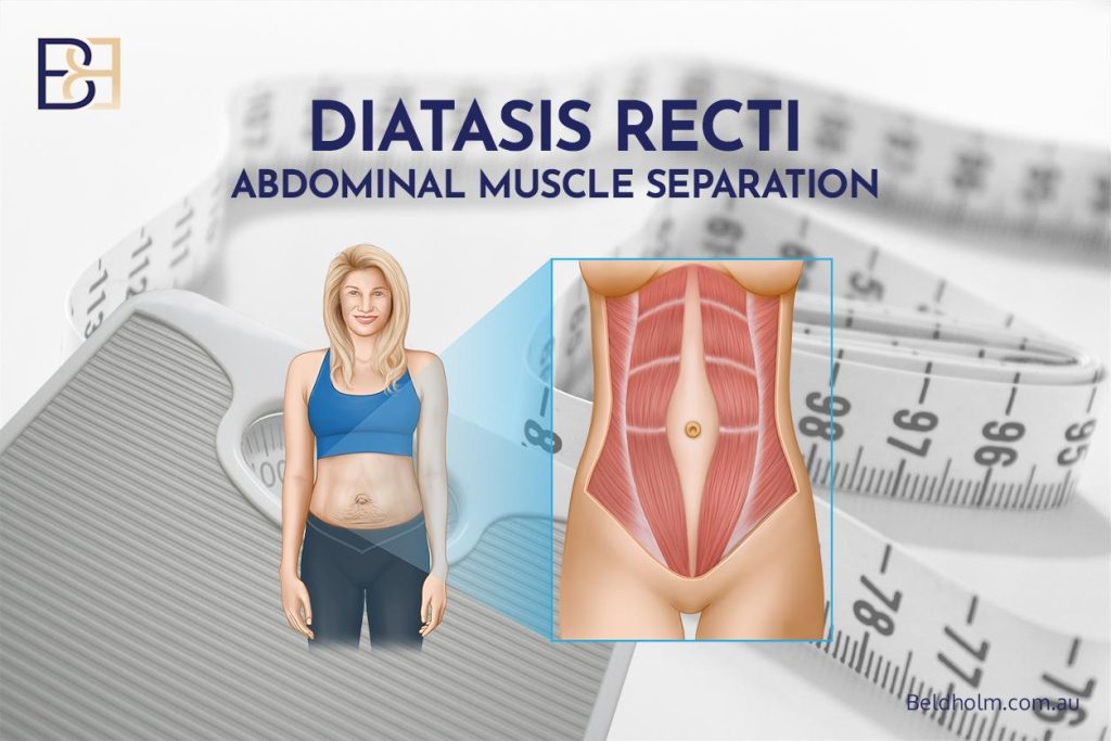 Tummy Tuck After Weight Loss (Abdominoplasty) 5 Abdominal Wall Assessment