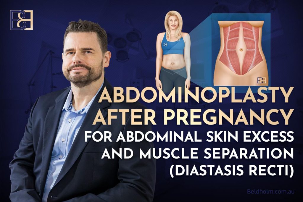 Abdominoplasty After Pregnancy for Abdominal Skin Excess and Muscle Separation (Diastasis Recti) 1 Abdominoplasty After Pregnancy for Abdominal Skin Excess and Muscle Separation (Diastasis Recti)