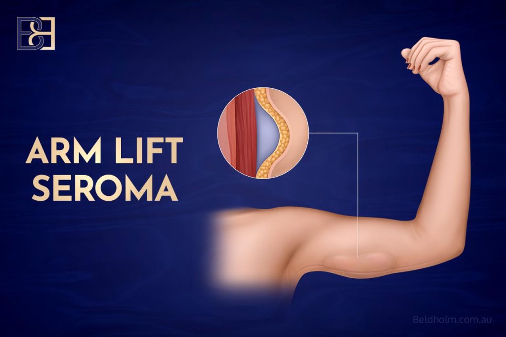 Arm Fat Removal Surgery 9 Arm Lift Seroma