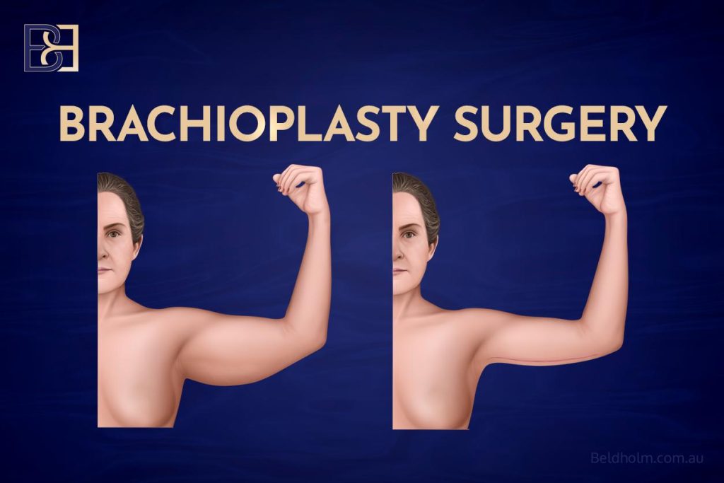 Arm Fat Removal Surgery 5 Arm Lift Surgery (Brachioplasty)