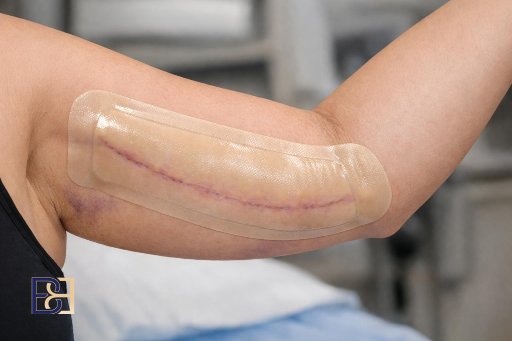 Brachioplasty (Arm Lift Surgery) 8 Brachioplasty Scars