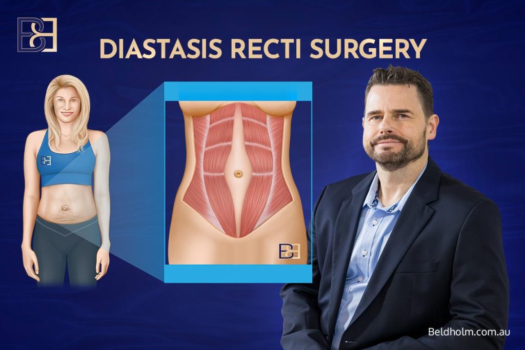 Diastasis Recti Surgery