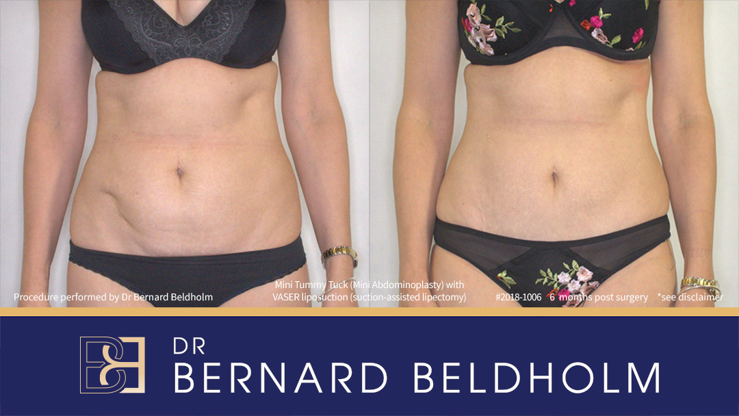 Mini Abdominoplasty Post Pregnancy Patient 2018-1006 - Front