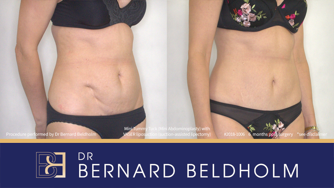 Mini Abdominoplasty Post Pregnancy Patient 2018-1006 2 Mini Abdominoplasty Post Pregnancy Patient 2018-1006 - Left