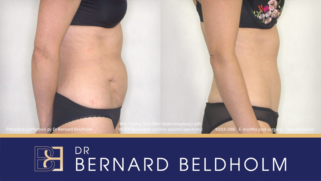 Mini Abdominoplasty Post Pregnancy Patient 2018-1006 3 Mini Abdominoplasty Post Pregnancy Patient 2018-1006 - Left Side