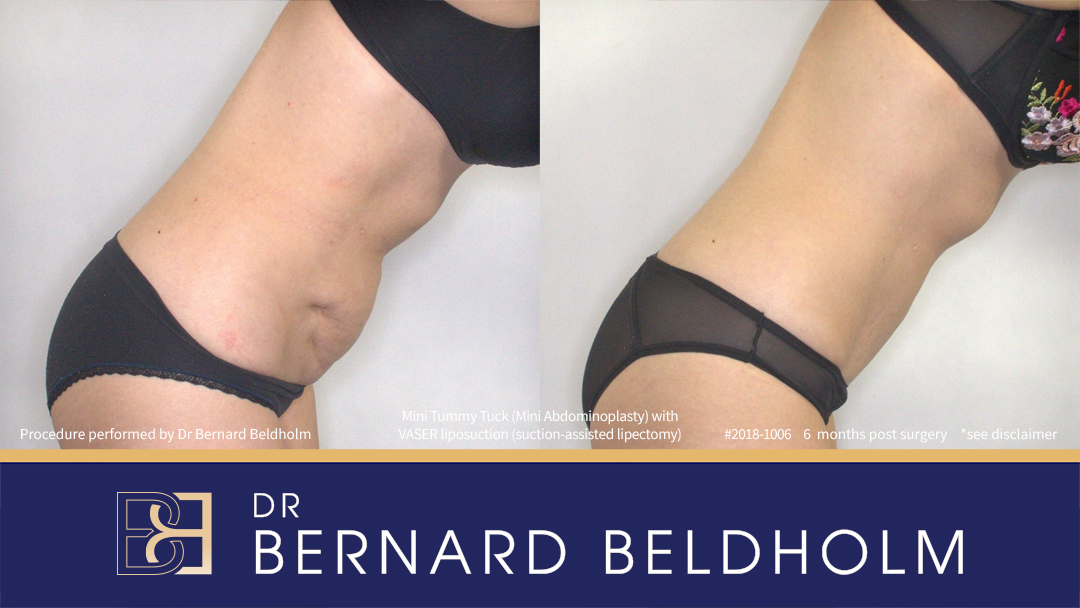 Mini Abdominoplasty Post Pregnancy Patient 2018-1006 4 Mini Abdominoplasty Post Pregnancy Patient 2018-1006 - Left Side Bend