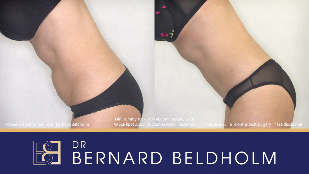 Mini Abdominoplasty Post Pregnancy Patient 2018-1006 5 Mini Abdominoplasty Post Pregnancy Patient 2018-1006 - Right Side Bend