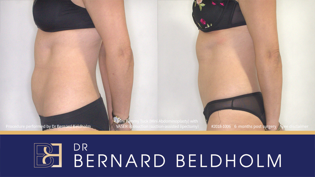 Mini Abdominoplasty Post Pregnancy Patient 2018-1006 6 Mini Abdominoplasty Post Pregnancy Patient 2018-1006 - Right Side