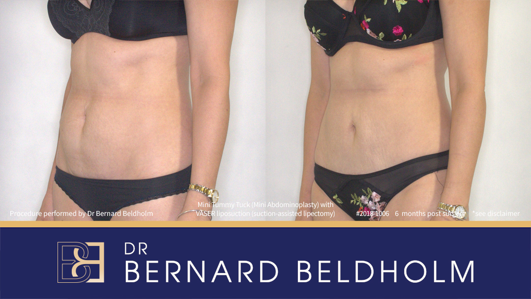 Mini Abdominoplasty Post Pregnancy Patient 2018-1006 7 Mini Abdominoplasty Post Pregnancy Patient 2018-1006 - Right