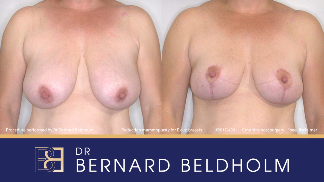 Patient 2017-4001 - Reduction Mammoplasty (Breast Reduction)