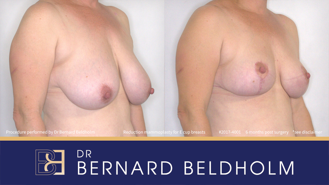 Reduction Mammoplasty (Breast Reduction) Patient 2017-4001 - Left