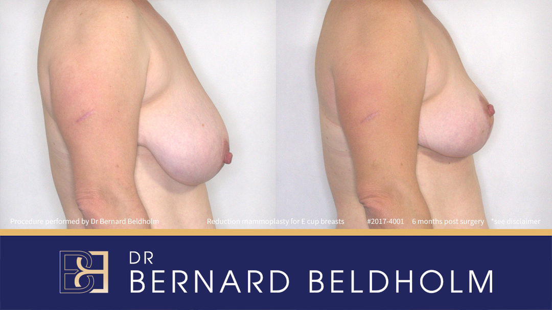 Reduction Mammoplasty (Breast Reduction) Patient 2017-4001 - Left Side
