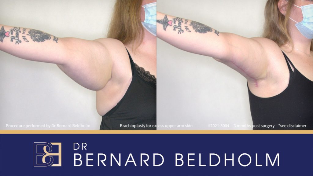 Brachioplasty Patient 2021-5004 - Right