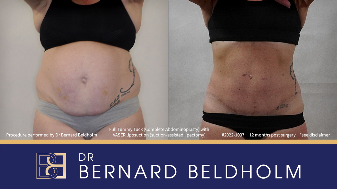 Abdominoplasty Post Pregnancy Patient 2022-1037 - Front