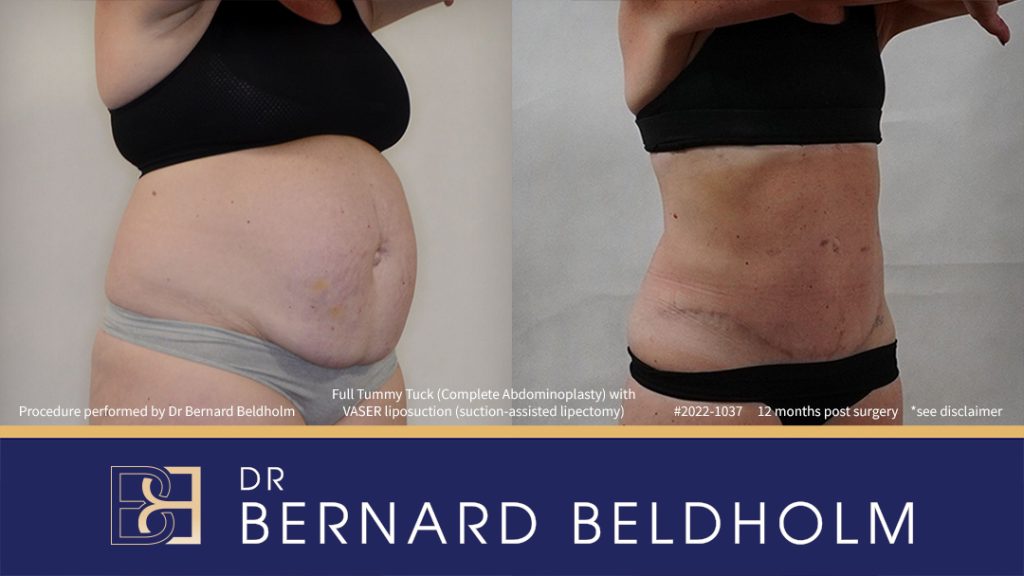 Abdominoplasty Post Pregnancy Patient 2022-1037 - Left