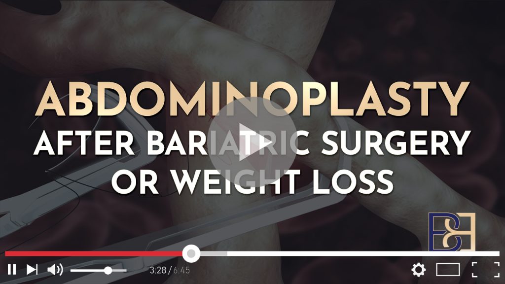 Understanding Abdominoplasty Post Weight Loss and Bariatric Surgery 1 Understanding Abdominoplasty Post Weight Loss and Bariatric Surgery