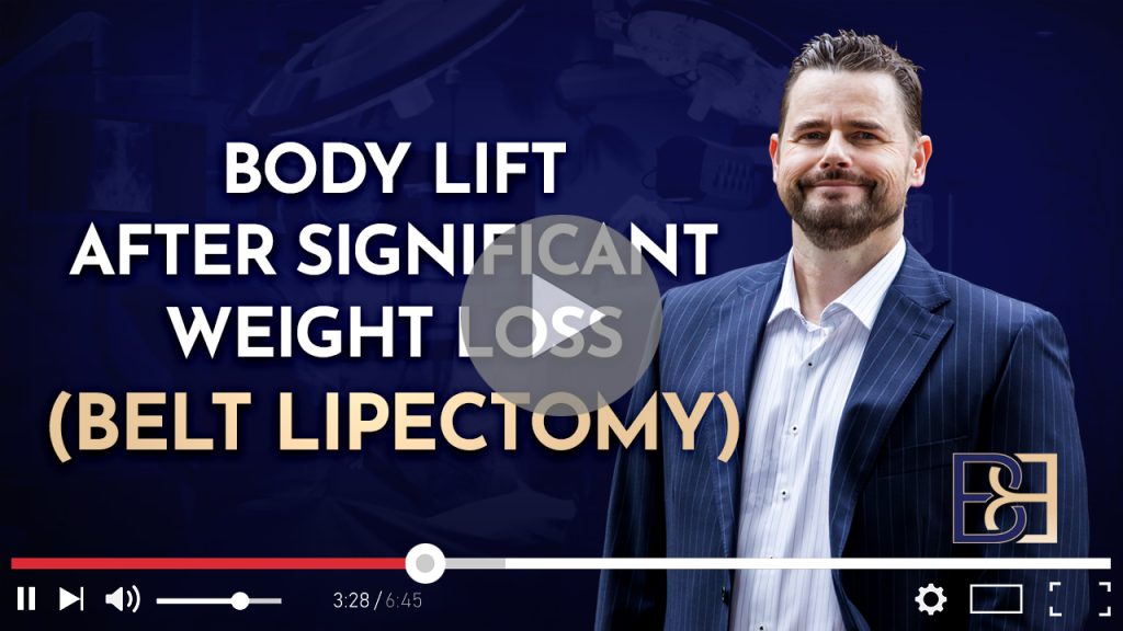 Body Lift After Significant Weight Loss (Belt Lipectomy)