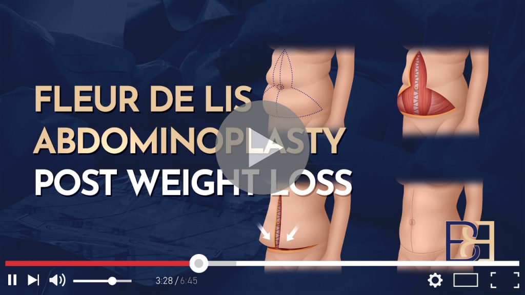 Fleur‑de‑Lis Abdominoplasty Post‑Weight Loss 1 Fleur‑de‑Lis Abdominoplasty Post‑Weight Loss