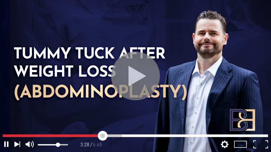 Tummy Tuck After Weight Loss (Abdominoplasty) 1 Tummy Tuck Abdominoplasty