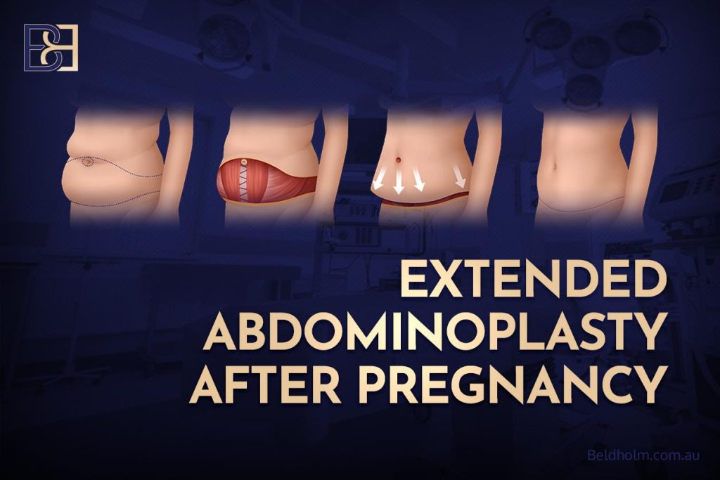 Extended Abdominoplasty After Pregnancy