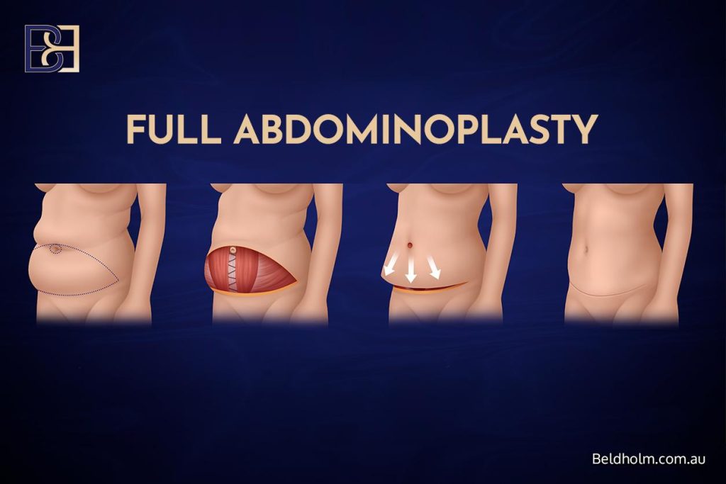 Apronectomy vs Abdominoplasty