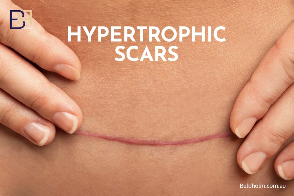Hyperthropic Scars