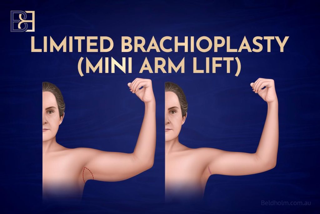 Brachioplasty (Arm Lift Surgery) 4 Limited (Mini) Brachioplasty
