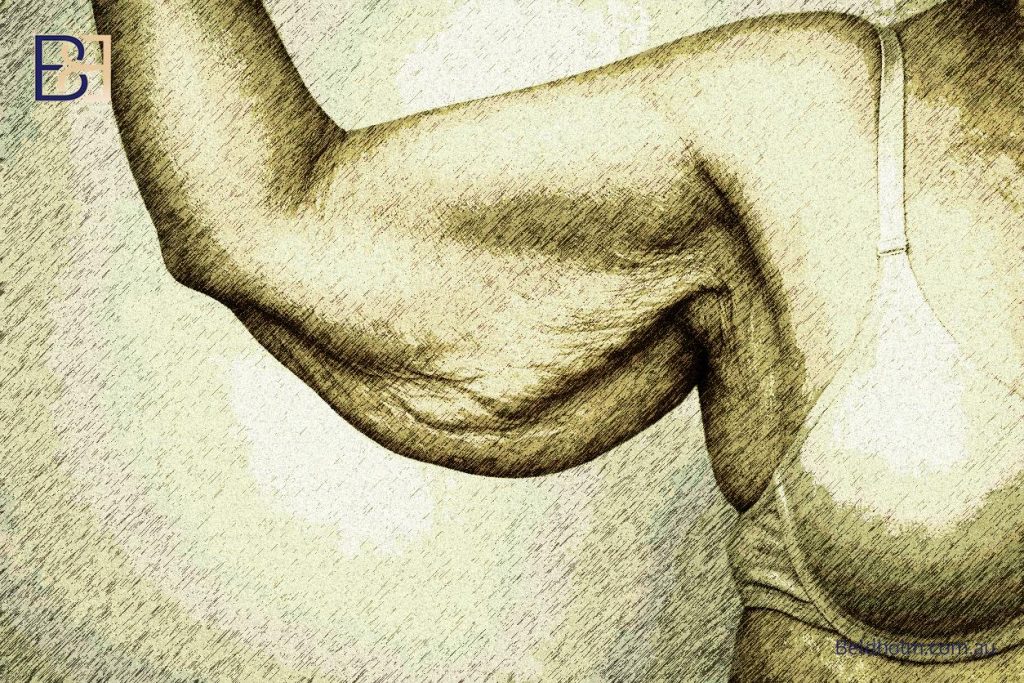Arm Fat Removal Surgery 6 Who Is a Candidate for Arm Fat Removal