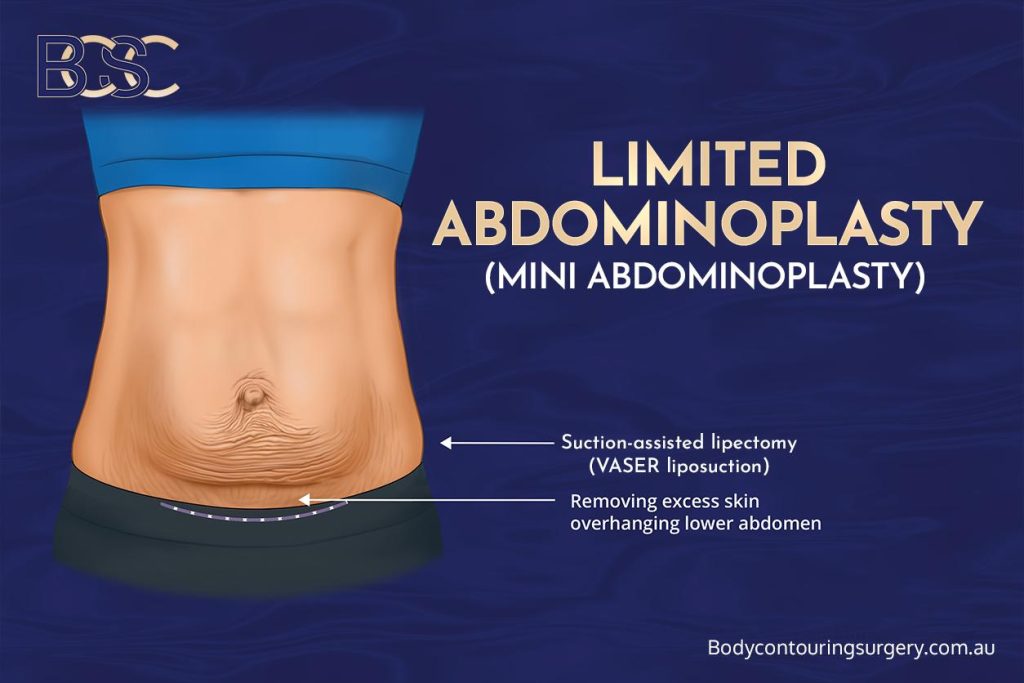 Abdominoplasty After Pregnancy for Abdominal Skin Excess and Muscle Separation (Diastasis Recti) 9 Mini (Limited) Abdominoplasty