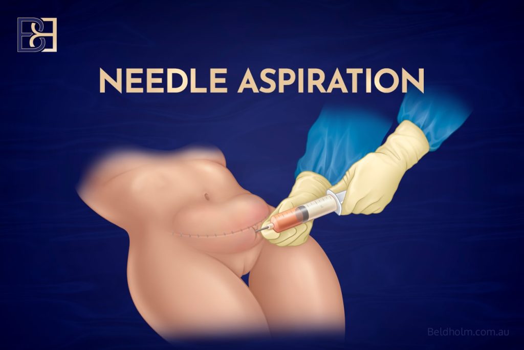 Needle aspiration