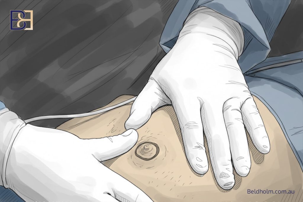 Complications After Upper Torsoplasty (upper body lift) Surgery in Men: Anterior Torsoplasty, Circumferential Torsoplasty, and VASER-Assisted Upper Body Lift Surgery 6 Nipple–Areola Complex Complications