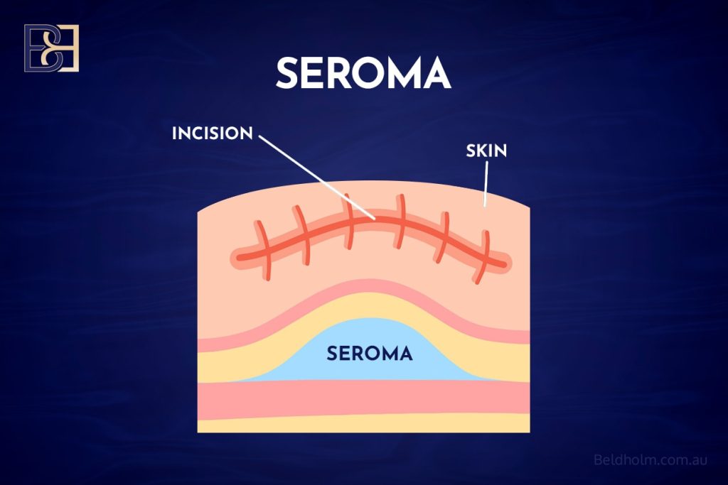 Complications After Upper Torsoplasty (upper body lift) Surgery in Men: Anterior Torsoplasty, Circumferential Torsoplasty, and VASER-Assisted Upper Body Lift Surgery 3 Seroma Formation After Upper Body Lift (torsoplasty) Surgery