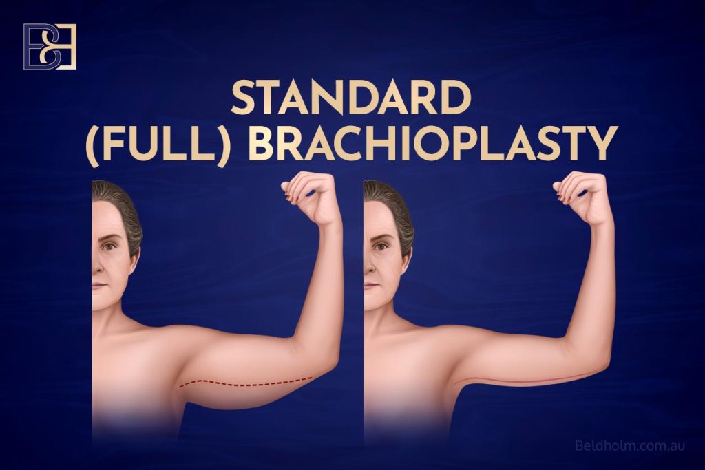 Brachioplasty (Arm Lift Surgery) 5 Standard Brachioplasty