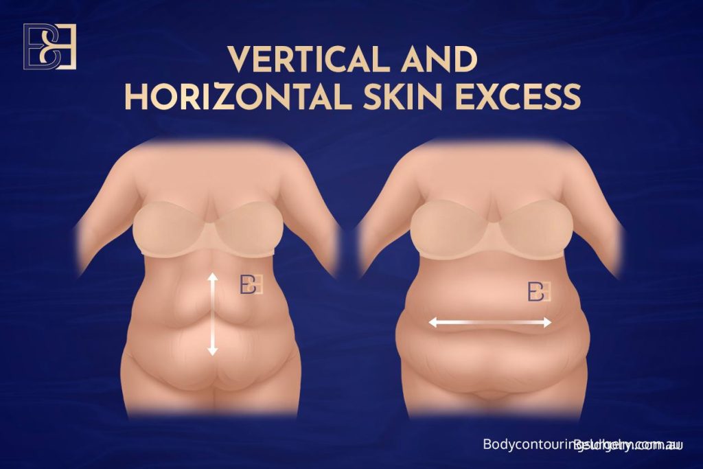 Vertical and Horizontal Skin Excess