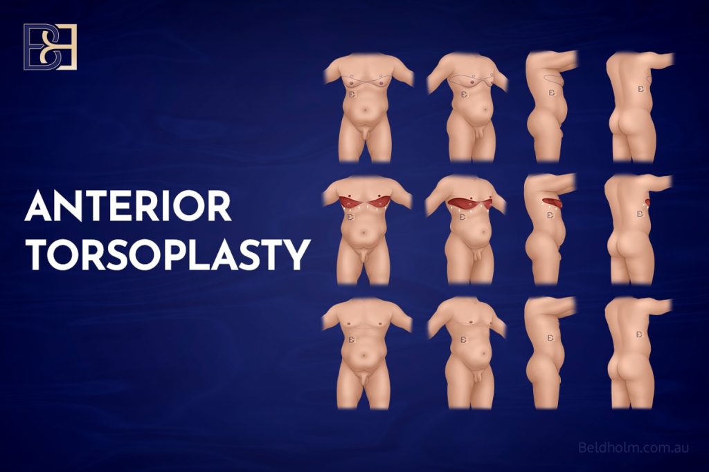 Male Chest Surgery Post-Weight Loss: Understanding Upper Body Lift (Torsoplasty) 9 Anterior Torsoplasty (Anterior chest lipectomy, or male mastectomy)