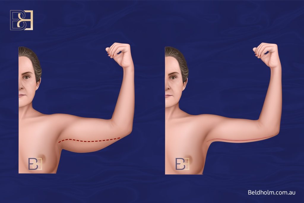 Brachioplasty (Arm Lift) Post Weight Loss 1 Brachioplasty - Arm Lift