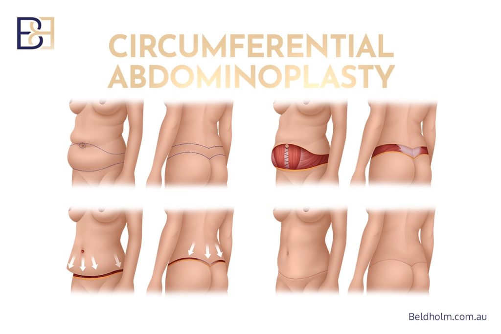 Circumferential Abdominoplasty (Lower Body Lift or belt lipectomy)