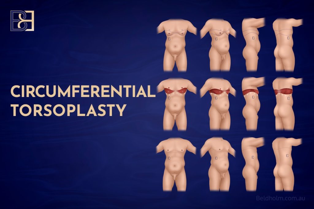 Male Chest Surgery Post-Weight Loss: Understanding Upper Body Lift (Torsoplasty) 10 Circumferential Torsoplasty
