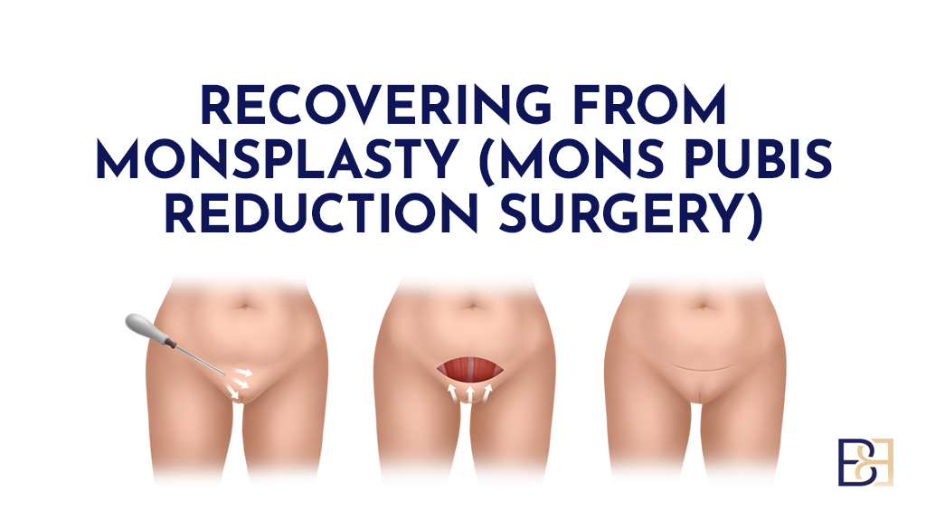 Recovering from Monsplasty (Mons Pubis Reduction Surgery)