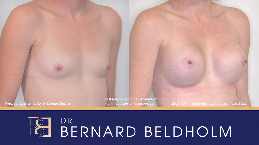 Round Breast Implants (Augmentation Mammoplasty) Patient 2017-2007