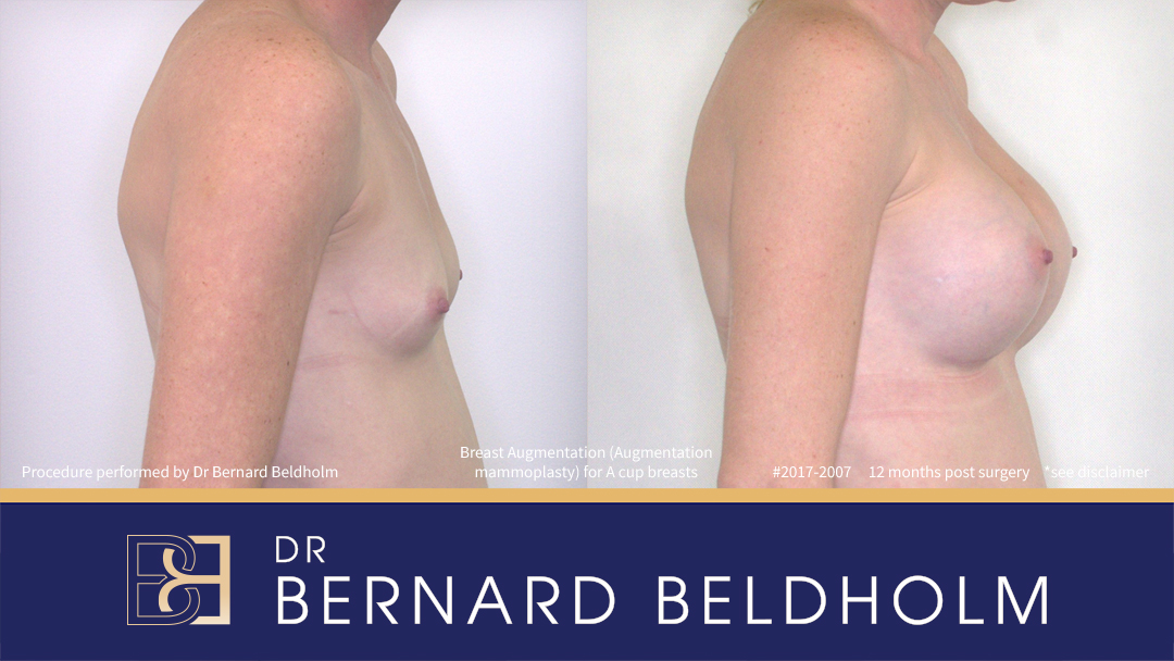 Round Breast Implants (Augmentation Mammoplasty) Patient 2017-2007