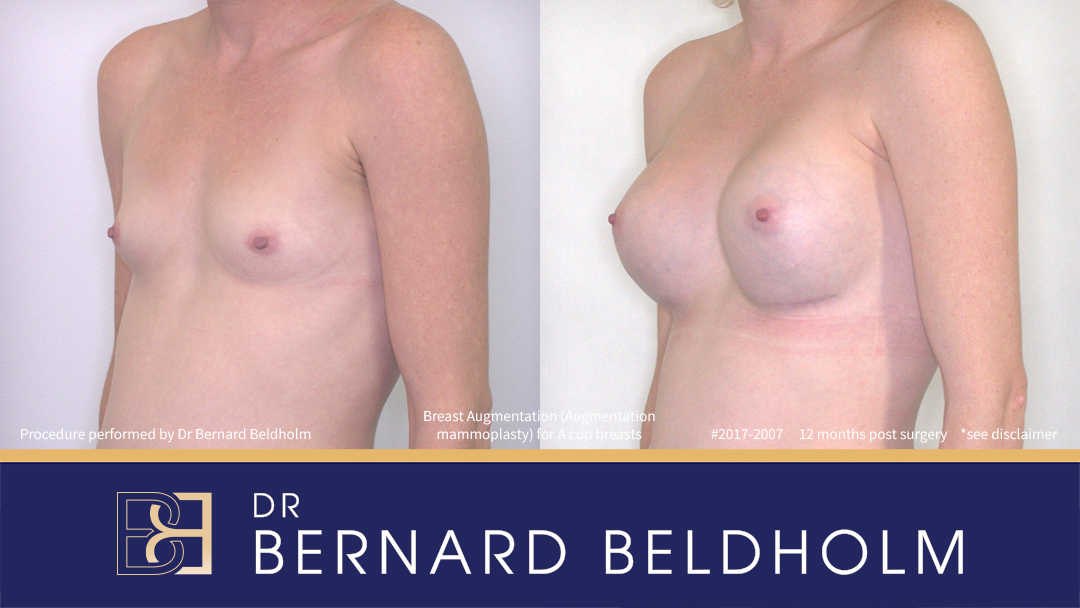 Round Breast Implants (Augmentation Mammoplasty) Patient 2017-2007