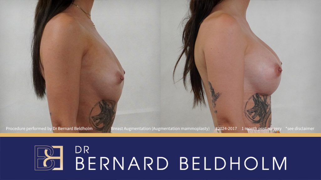 Patient 2024-2017 - Breast Augmentation (Augmentation Mammoplasty) - Left Side